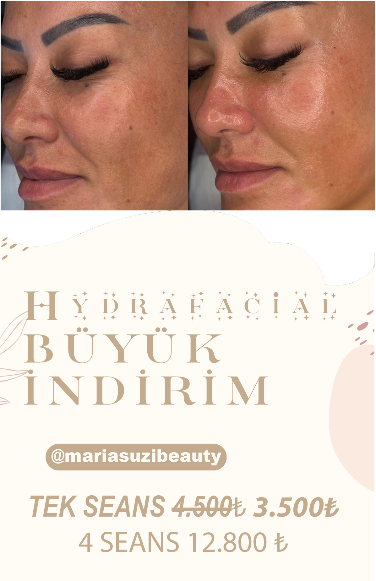 Hydrafacial Cilt Bakımı